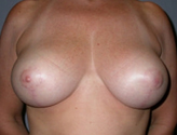Patient # 87772 After Photo # 2